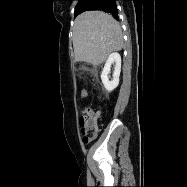 File:Acute pancreatitis (Radiopaedia 69236-79012 Sagittal C+ portal venous phase 73).jpg