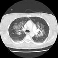 Acute pulmonary edema on CT (Radiopaedia 33582-34672 Axial lung window 18).jpg