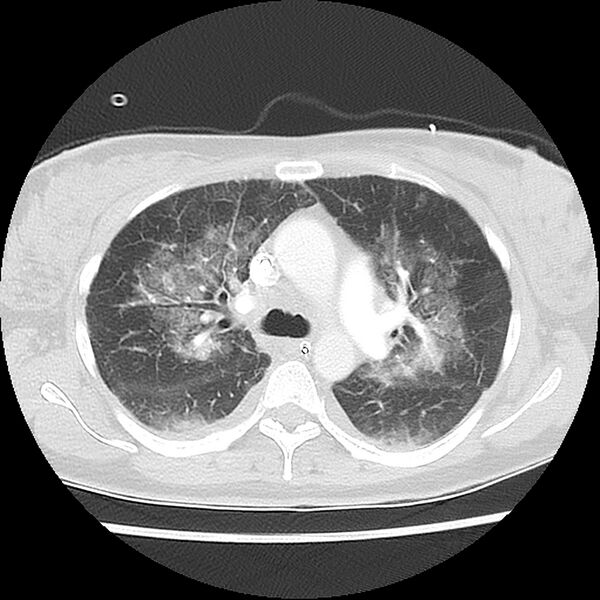 File:Acute pulmonary edema on CT (Radiopaedia 33582-34672 Axial lung window 18).jpg