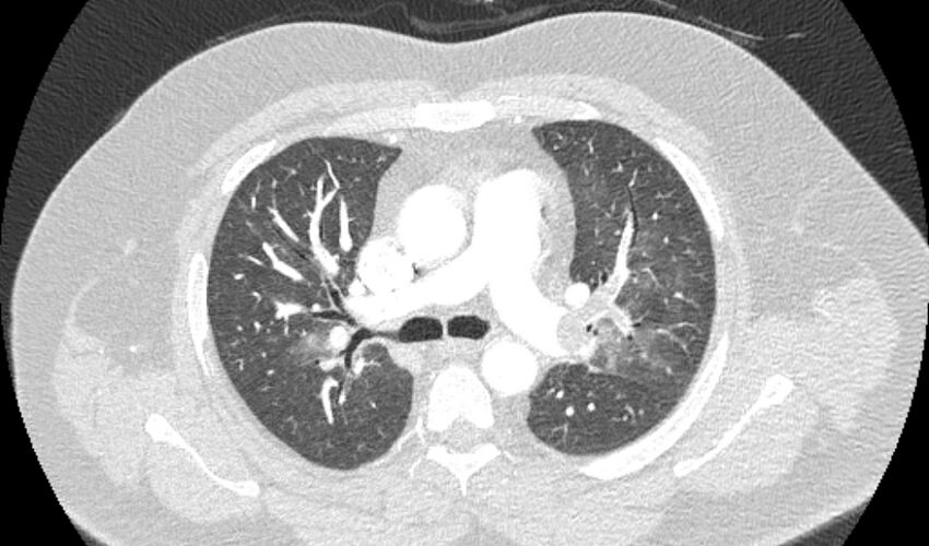 Acute pulmonary embolism with pulmonary infarcts (Radiopaedia 77688-89908 Axial lung window 42).jpg