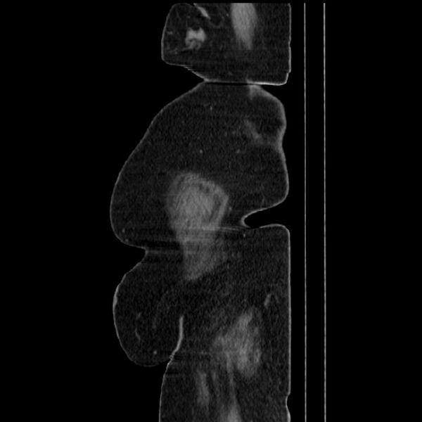 File:Acute pyelonephritis (Radiopaedia 25657-25837 Sagittal renal parenchymal phase 75).jpg