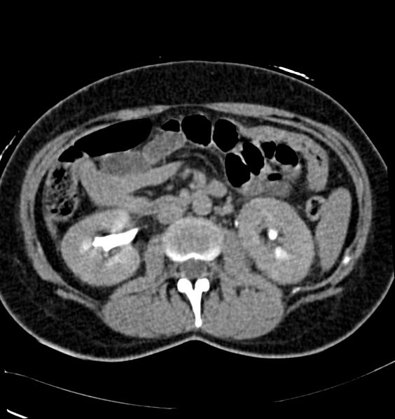 File:Acute pyelonephritis (Radiopaedia 40264-42816 Axial renal excretory phase 11).jpg