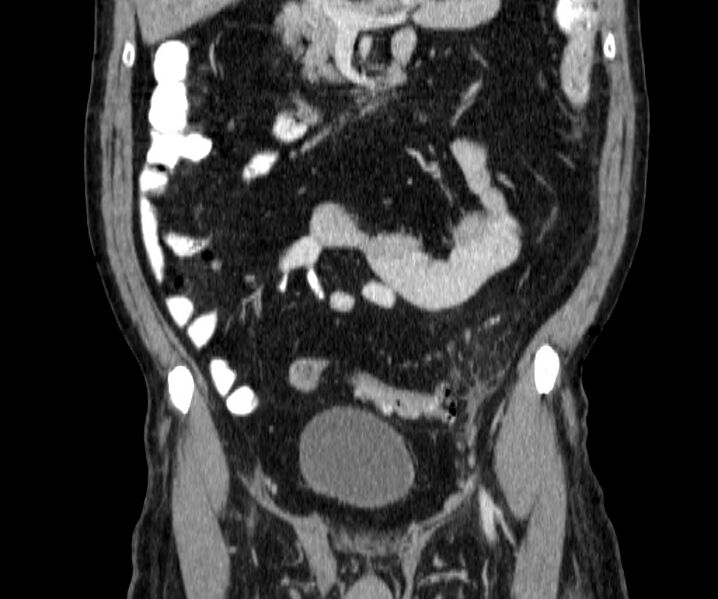 File:Acute sigmoid colon diverticulitis (Radiopaedia 55507-61976 Coronal C+ portal venous phase 55).jpg