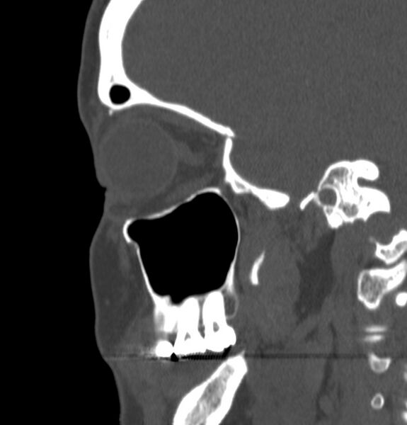 File:Acute sinusitis (Radiopaedia 22419-22455 Sagittal non-contrast 6).jpg
