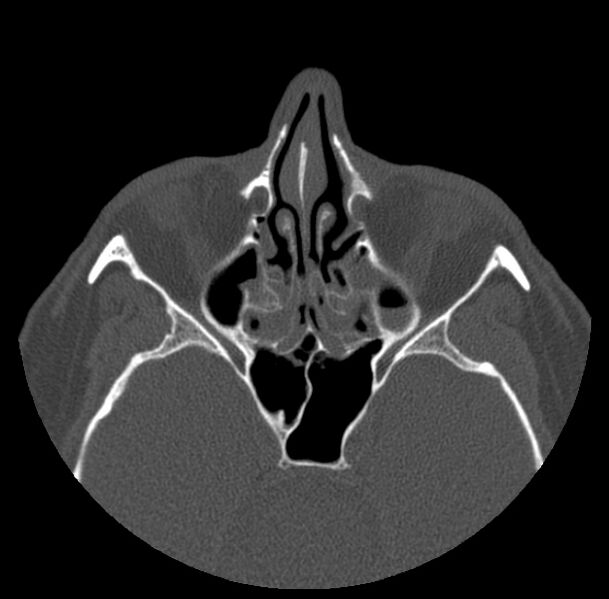 File:Acute sinusitis (Radiopaedia 23161-23215 Axial bone window 37).jpg