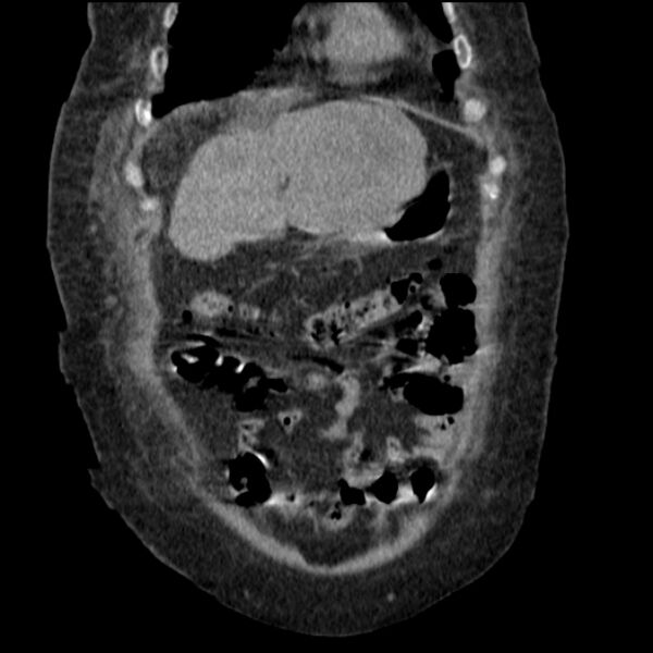 File:Acute tubular necrosis (Radiopaedia 28077-28334 D 22).jpg