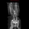 Adenocarcinoma of the colon (Radiopaedia 8191-9039 Coronal liver window 44).jpg