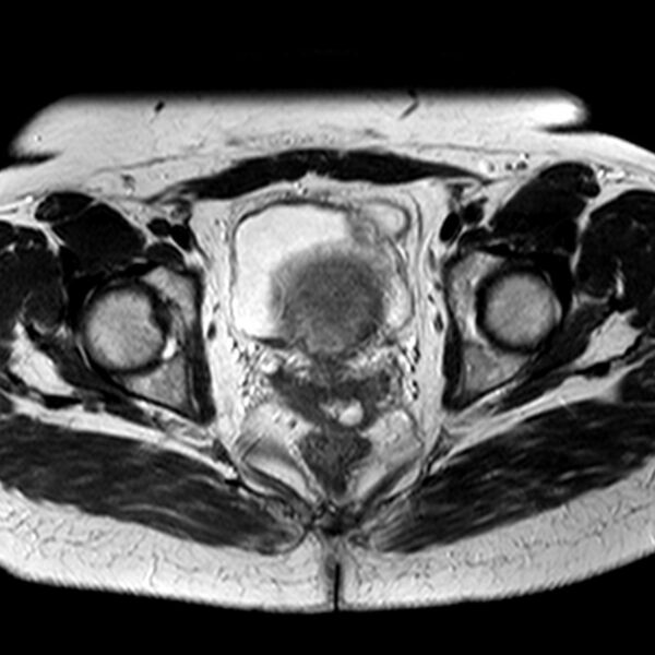 File:Adenomyoma of the uterus (Radiopaedia 9871-10439 Axial T2 12).jpg