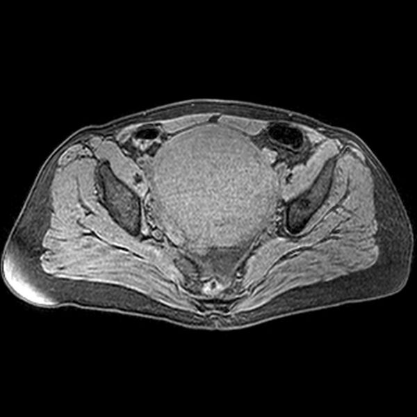 File:Adenomyoma of the uterus (huge) (Radiopaedia 9870-10438 Axial T1 fat sat 16).jpg