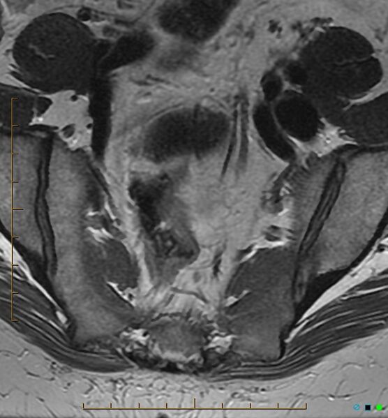 File:Adenomyosis uterus with hematometra (Radiopaedia 45779-50011 Axial T2 3).jpg