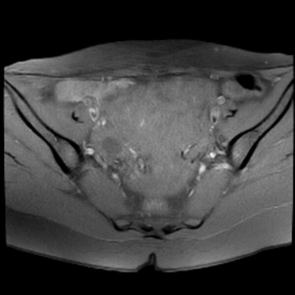 File:Adenomyosis within a septate uterus (Radiopaedia 69963-79981 Axial T1 fat sat 13).jpg