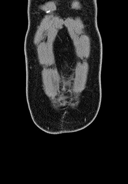 File:Adhesional small bowel obstruction (Radiopaedia 58900-66131 Coronal C+ portal venous phase 58).jpg