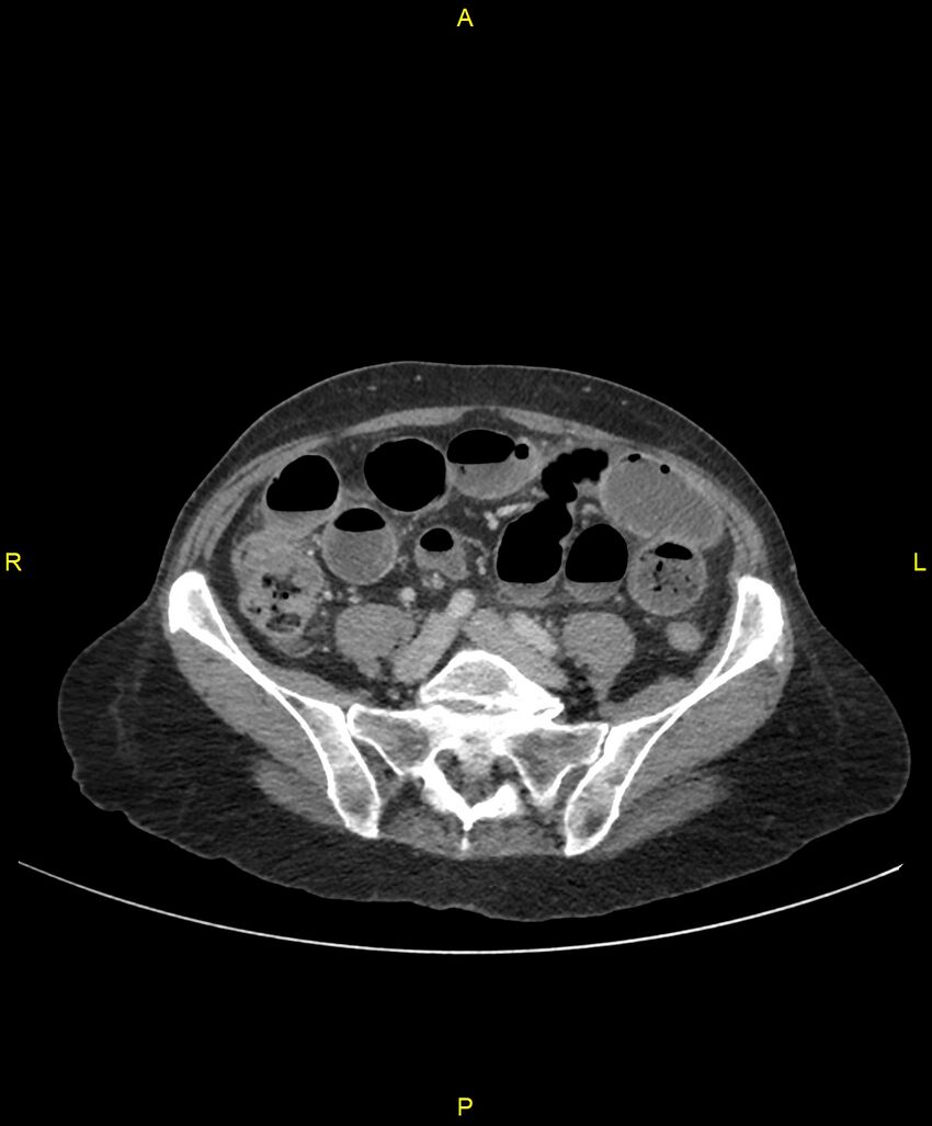 Adhesional small bowel obstruction (Radiopaedia 85402-101024 Axial C+ portal venous phase 194).jpg