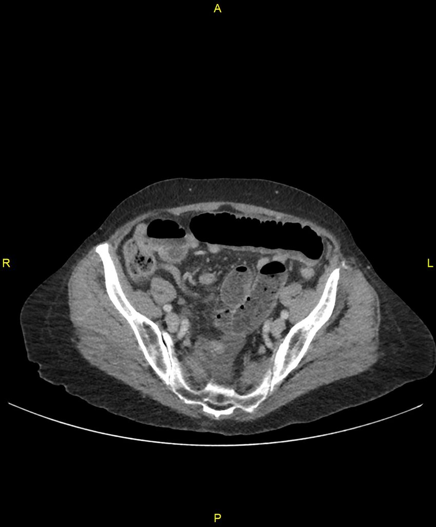 Adhesional small bowel obstruction (Radiopaedia 85402-101024 Axial C+ portal venous phase 222).jpg