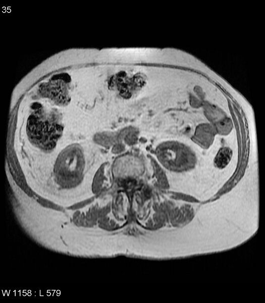 File:Adrenal myelolipoma (Radiopaedia 6765-7961 Axial T1 in-phase 35).jpg