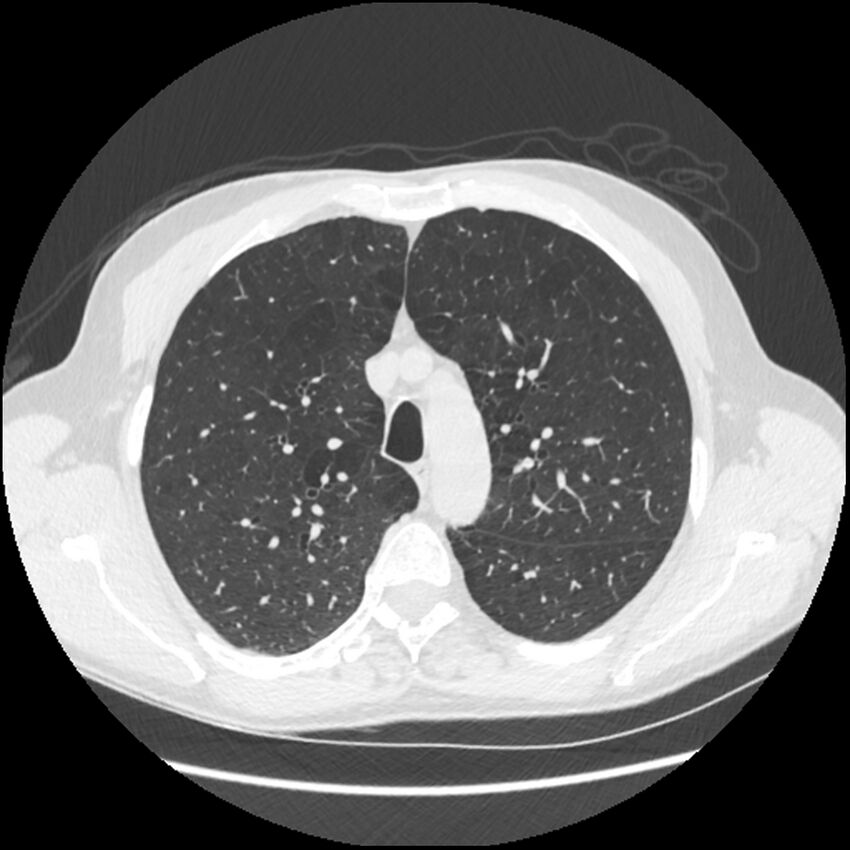 Alpha-1-antitrypsin deficiency (Radiopaedia 40993-43722 Axial lung window 63).jpg
