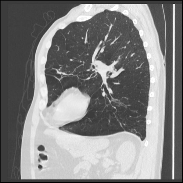 File:Alpha-1-antitrypsin deficiency (Radiopaedia 40993-43722 Sagittal lung window 93).jpg