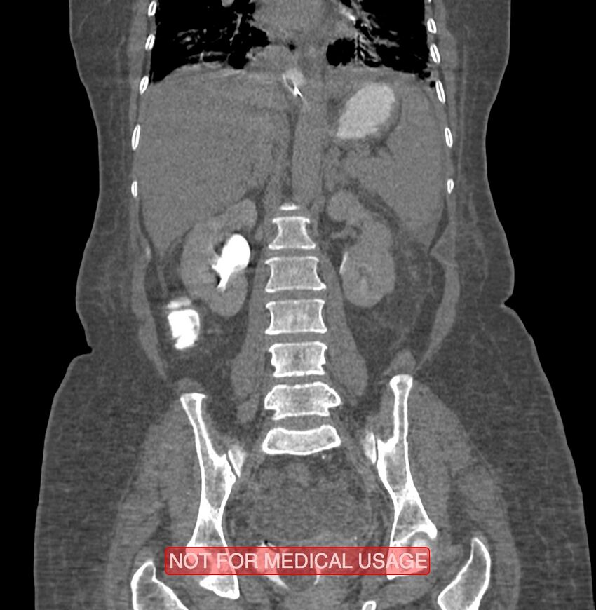 Amoebic enterocolitis with liver abscess (Radiopaedia 35100-36609 B 128).jpg