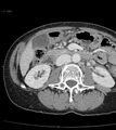Ampulla of Vater metastasis (Radiopaedia 27820-28065 A 40).jpg