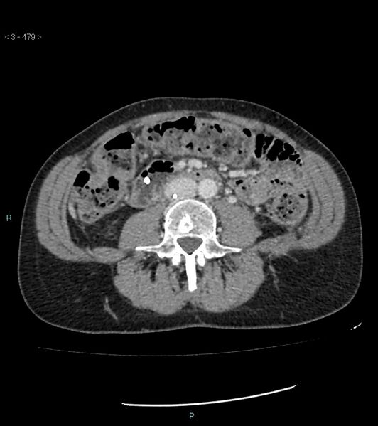 File:Ampulla of Vater metastasis (Radiopaedia 27820-28069 A 117).jpg