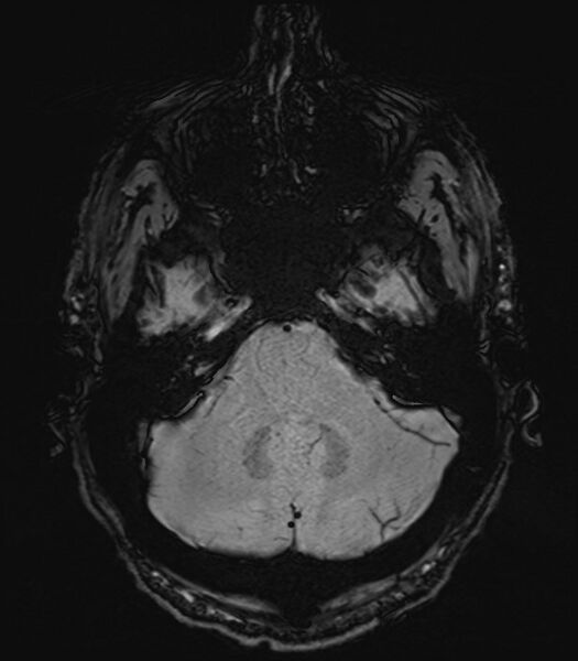 File:Amyotrophic lateral sclerosis (Radiopaedia 87352-103658 Axial SWI 7).jpg