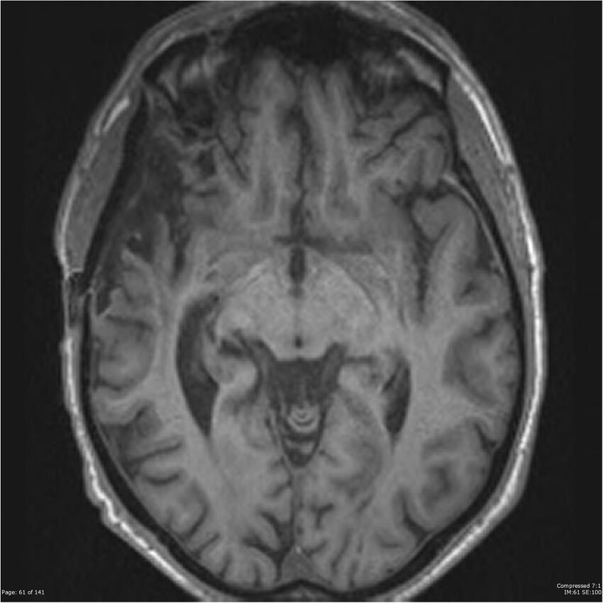 Anaplastic meningioma with recurrence (Radiopaedia 34452-35788 Axial T1 59).jpg