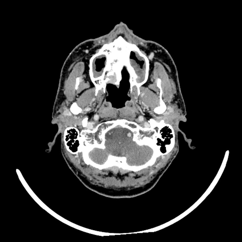 Anaplastic thyroid carcinoma (Radiopaedia 79087-92034 B 110).jpg