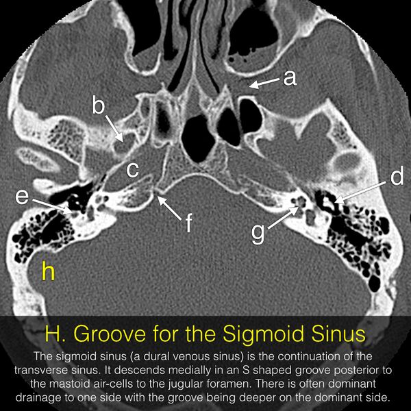 File:Anatomy Quiz (Skull base) (Radiopaedia 41833-44822 Axial 17).jpeg
