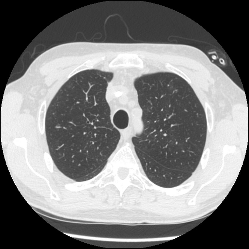Angioinvasive aspergillosis (Radiopaedia 43957-47466 Axial lung window 19).jpg