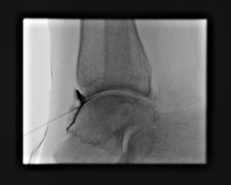 File:Ankle joint injection (fluoroscopic guided) (Radiopaedia 87288-103578 Lateral 21).jpg