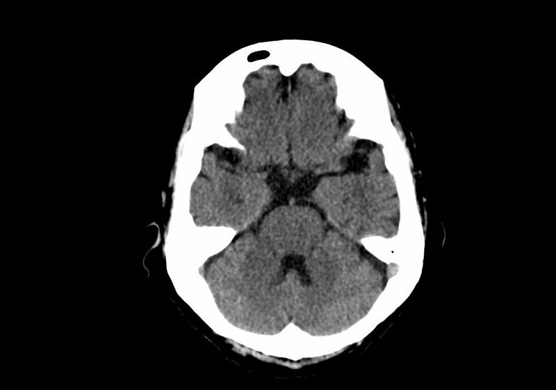 File:Anomalous intracranial venous drainage (Radiopaedia 28161-28418 Axial non-contrast 13).jpg