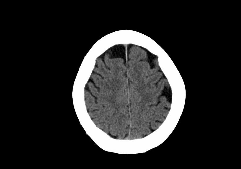 File:Anomalous intracranial venous drainage (Radiopaedia 28161-28418 Axial non-contrast 36).jpg