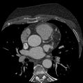 Anomalous origin of left circumflex artery from right coronary sinus (Radiopaedia 72563-83117 B 39).jpg