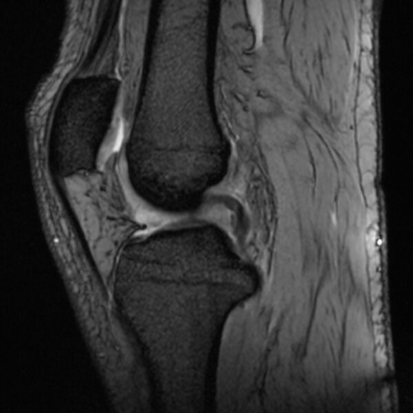 File:Anterior cruciate ligament tear - ramp lesion (Radiopaedia 71883-82322 Sagittal T2 fat sat 14).jpg