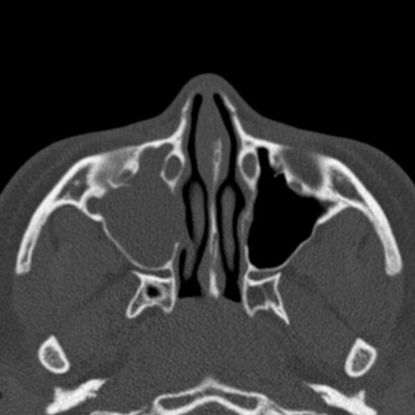 File:Antrochoanal polyp (Radiopaedia 33984-35202 Axial bone window 31).jpg