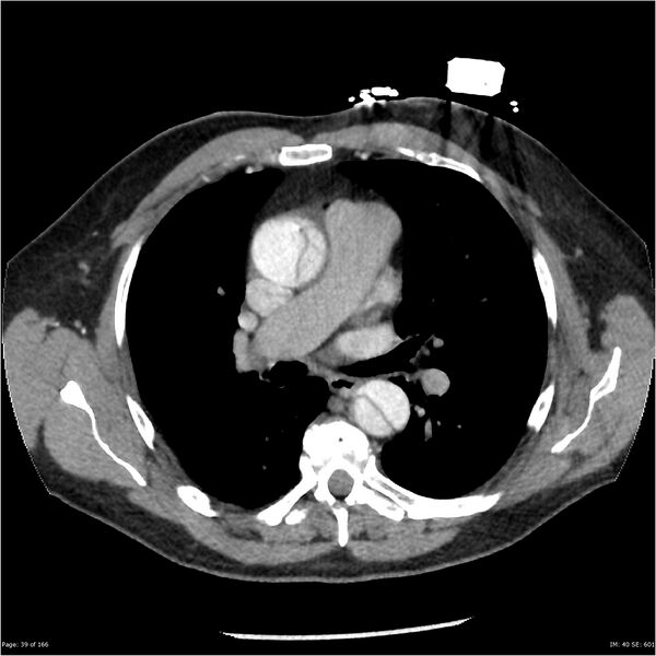 File:Aortic dissection- Stanford A (Radiopaedia 37759-39664 A 30).jpg
