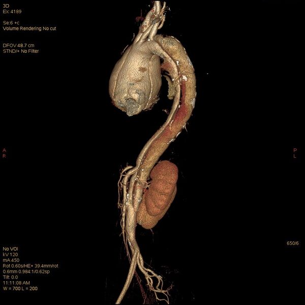 File:Aortic dissection (Radiopaedia 25350-25604 E 6).jpg