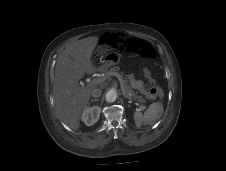 File:Aortic dissection (Radiopaedia 28802-29105 A 46).jpg