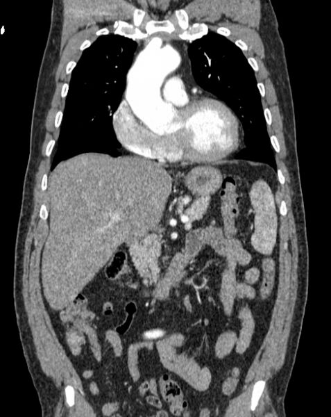 File:Aortic dissection (Radiopaedia 44411-48061 A 12).jpg