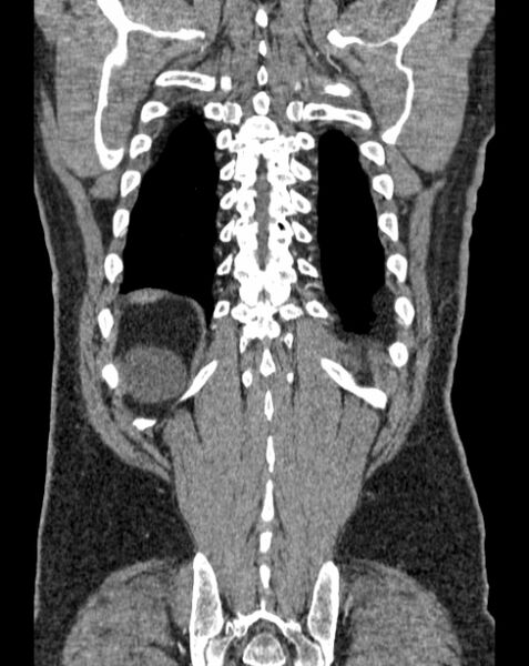 File:Aortic dissection (Radiopaedia 44411-48061 A 63).jpg
