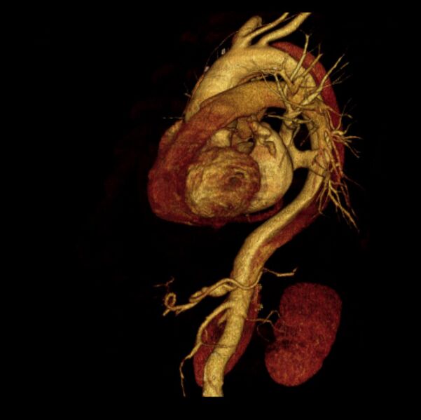 File:Aortic dissection with rupture into pericardium (Radiopaedia 12384-12647 D 31).jpg