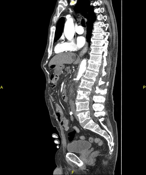 File:Aortoenteric fistula (Radiopaedia 84308-99603 C 171).jpg