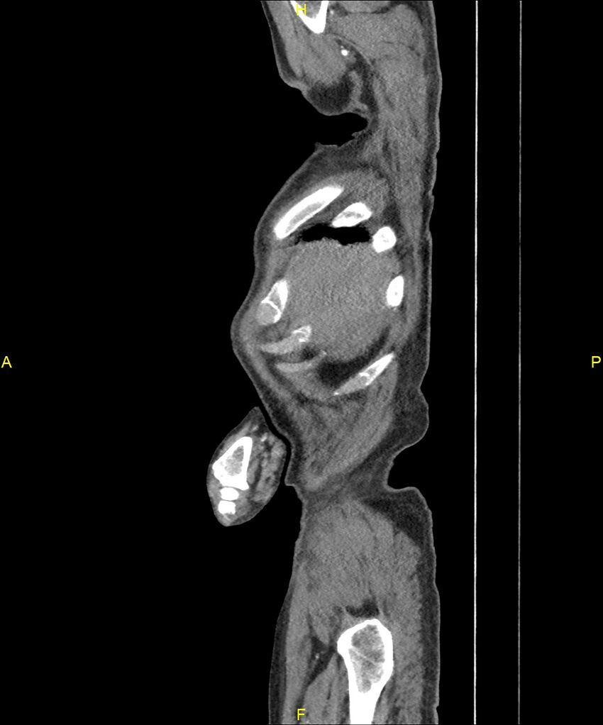 Aortoenteric fistula (Radiopaedia 84308-99603 C 25).jpg