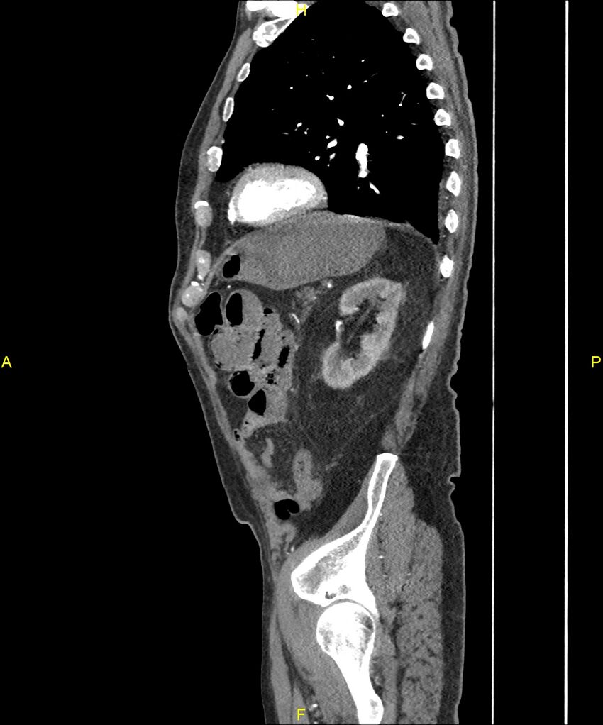 Aortoenteric fistula (Radiopaedia 84308-99603 C 256).jpg