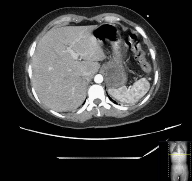 File:Appendicitis (CT angiogram) (Radiopaedia 154713-127660 Axial 161).jpg
