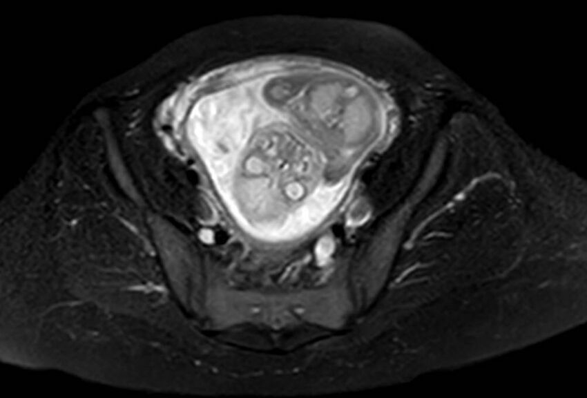 Appendicitis in gravida (MRI) (Radiopaedia 89433-106395 Axial T2 SPAIR 60).jpg
