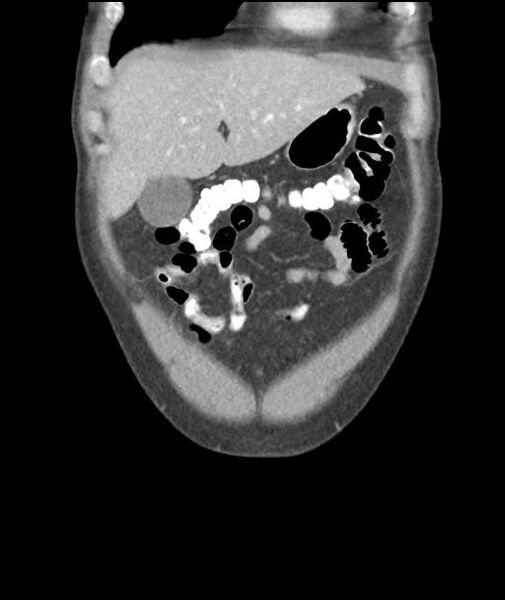 File:Appendicitis with cecal bar sign (Radiopaedia 31878-32830 A 15).jpg