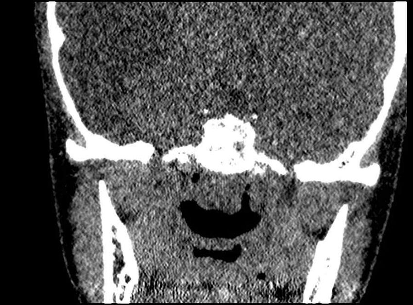 Arachnoid cyst- extremely large (Radiopaedia 68741-78450 Coronal bone window 7).jpg