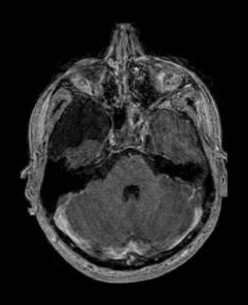File:Arachnoid cyst- extremely large (Radiopaedia 68741-78451 Axial T1 C+ 24).jpg