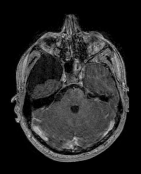 File:Arachnoid cyst- extremely large (Radiopaedia 68741-78451 Axial T1 C+ 25).jpg